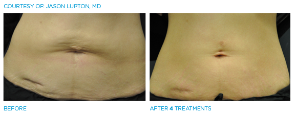 Your new secret weapon in the Battle against the Muffin top!